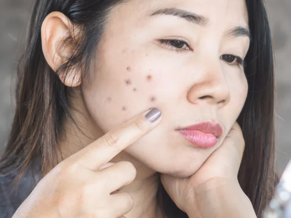 Acne Scars Kharadi