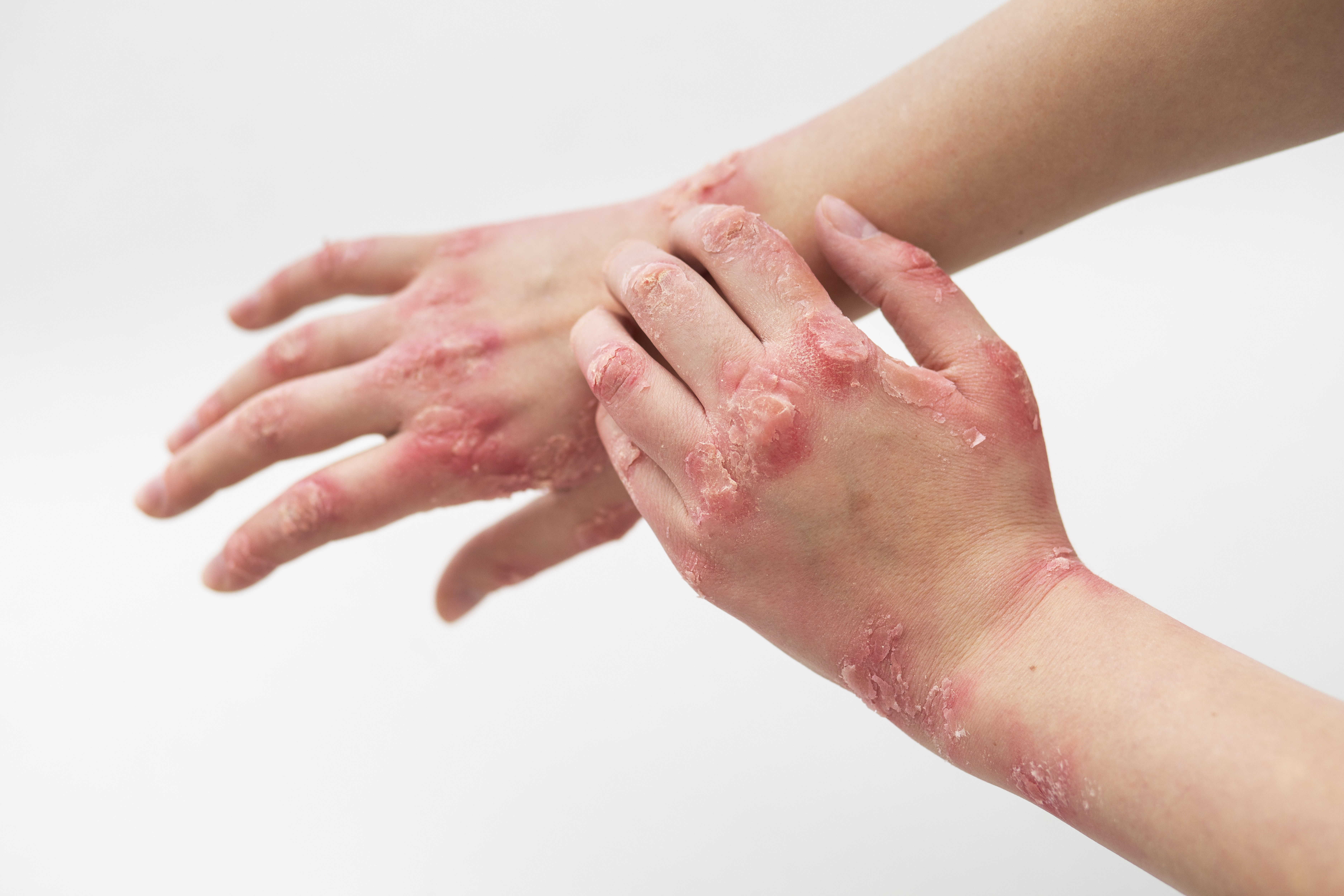 Eczema Kharadi